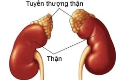 Lạm dụng corticoid ở trẻ nhỏ có thể gây hội chứng Cushing nghiêm trọng
