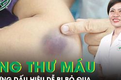 Những dấu hiệu ung thư máu dễ bị bỏ qua