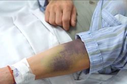 Sốt cao liên tục, hết sốt chưa hết nguy hiểm: Cảnh giác bệnh truyền nhiễm này