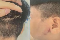 Triệu tập người cha nghi đánh con ruột nhập viện