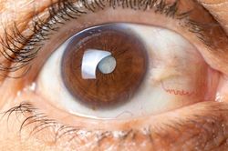 Phát hiện mới: Vitamin B3 giảm 66% nguy cơ mắc glôcôm ở người tăng nhãn áp?