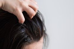 Nhiều người khổ sở vì gàu, bác sĩ chỉ 6 mẹo đơn giản giúp kiểm soát