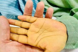Tuổi 23 bàng hoàng với căn bệnh ác tính 'không còn làm gì được nữa'