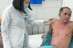 Dị ứng thuốc nhỏ mắt, người đàn ông bị hoại tử thượng bì nhiễm độc nguy kịch