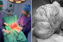 Bụng to tưởng tăng cân, người phụ nữ đi khám phát hiện khối u gần 3 kg