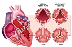 Nặng chân cuối ngày, cảnh giác dấu hiệu bệnh van tim