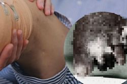 Nghe lời truyền miệng, ngâm chân nước trà xanh nóng, người đàn ông 66 tuổi phải cắt cụt chân