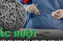 Bé gái 9 tuổi bị tắc ruột do một búi giun đũa hơn 200 con làm tổ