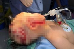 Bé trai 26 tháng tuổi bị chó nhà cắn nát vùng hàm mặt