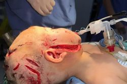 Kịp thời cứu sống bé trai 26 tháng tuổi bị chó nhà cắn nát vùng hàm mặt
