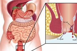 6 sai lầm khiến nhiều người điều trị trĩ thất bại