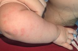 Bé 2 tháng xuất hiện viền vẩy khắp người, đi khám phát hiện giang mai