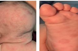 Hồi chuông cảnh báo đáng lo ngại về trẻ mắc bệnh giang mai bẩm sinh