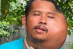 Người đàn ông có khuôn mặt biến dạng đến khó tin chỉ vì một thói quen mà nhiều người vẫn làm mỗi ngày