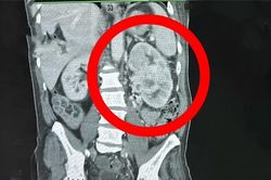 Trước cả đồ ăn, đây mới là thứ tàn phá thận của bạn âm thầm