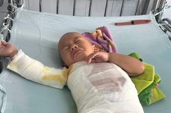 Mong cộng đồng giúp đỡ bé trai vùng cao ngã vào nồi nước sôi bị bỏng nặng