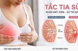 Bác sĩ cảnh báo biến chứng viêm vú khi tự 'thông tia' sữa