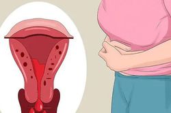 Người phụ nữ 53 tuổi thiếu máu nặng vì chủ quan với u xơ tử cung