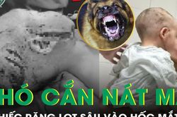 Bé trai 2 tuổi bị chó cắn nát vùng mặt