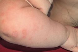 Bé gái 2 tháng tuổi mắc giang mai, nguy cơ nghiêm trọng nếu không được phát hiện