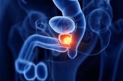 Dấu hiệu cho thấy ung thư tuyến tiền liệt không còn ở giai đoạn đầu