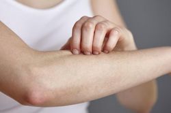Vì sao ngày càng nhiều người bị dị ứng?
