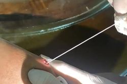 Người đàn ông tự nặn hai nốt trên tay, kéo ra giun rồng dài 20 cm