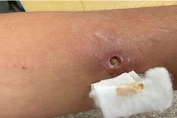 Thêm một ca giun rồng được phát hiện tại Việt Nam
