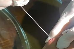 Ghi nhận trường hợp người đ&agrave;n &ocirc;ng mắc giun rồng thứ 44 tại Việt Nam