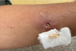 Ca giun rồng thứ 44 ở Việt Nam: K&eacute;o ra 2 đoạn giun d&agrave;i h&agrave;ng chục cm