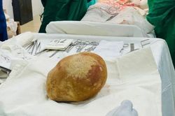 Người đàn ông 55 tuổi nhập viện vì đột quỵ, bác sĩ lấy ra viên sỏi nặng 3,1kg