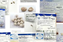 Uống thuốc 'gia truyền' mua tr&ecirc;n mạng, người đ&agrave;n &ocirc;ng bị G&uacute;t cấp nặng