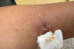 Nặn mụn trên cánh tay, người đàn ông 49 tuổi phát hiện giun rồng 20cm làm tổ