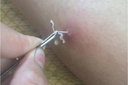 Giun rồng lại xuất hiện ở Việt Nam