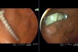 Bé gái 11 tháng tuổi suy hô hấp vì nuốt đinh vít dài 4 cm vào dạ dày