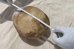 Lấy viên sỏi nặng 3,1kg ra khỏi bàng quang của người đàn ông 55 tuổi