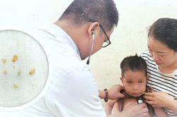 Cứu sống bé trai 2 tuổi hóc hạt lạc, bít kín hai bên phế quản