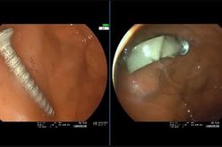 Bé gái 11 tháng tuổi nuốt đinh vít dài 4cm, bác sĩ cảnh báo phụ huynh
