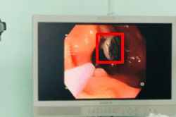 Ngậm đinh trong miệng, người đàn ông 50 tuổi gặp sự cố đáng sợ