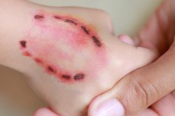 Bộ Y tế đề nghị các địa phương tăng cường giám sát người bị chó, mèo cắn, cào