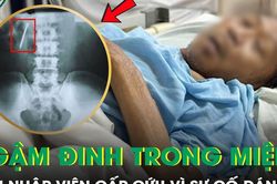 Ngậm đinh trong miệng, người đàn ông 50 tuổi phải nhập viện cấp cứu