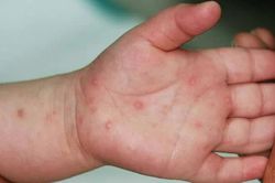 Lo dịch tay chân miệng tăng cao đầu năm học, Bộ Y tế khuyến cáo khẩn