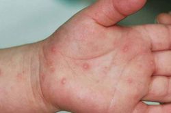 Ghi nhận 3.000 ca mắc tay ch&acirc;n miệng mỗi tuần, Bộ Y tế khuyến c&aacute;o khẩn