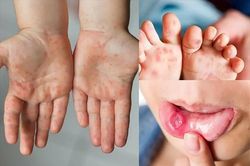 Gần 100.000 trẻ mắc tay chân miệng, Cục Phòng bệnh khuyến cáo khẩn