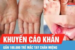 Gần 100.000 trẻ mắc tay chân miệng, Cục Phòng bệnh khuyến cáo khẩn
