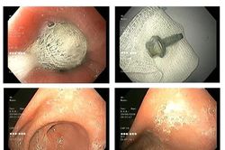 Bác sĩ khuyến cáo, cha mẹ cần chủ động phòng tránh dị vật ở trẻ