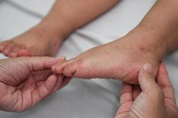 Bệnh gia tăng dịp đầu năm học, Bộ Y tế khuyến cáo '3 sạch'