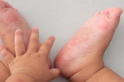 Ca mắc tay chân miệng tăng, chuyên gia khuyến cáo '3 sạch' để phòng bệnh