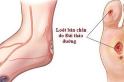 Tê rần bàn chân ở người tiểu đường cần chú ý biến chứng thần kinh
