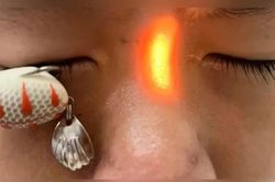 Lưỡi câu xuyên thủng giác mạc bé trai 13 tuổi, cảnh báo tai nạn trước thềm năm học mới